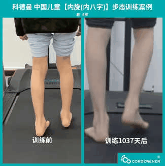 科德曼|儿童步态训练案例展示--内旋