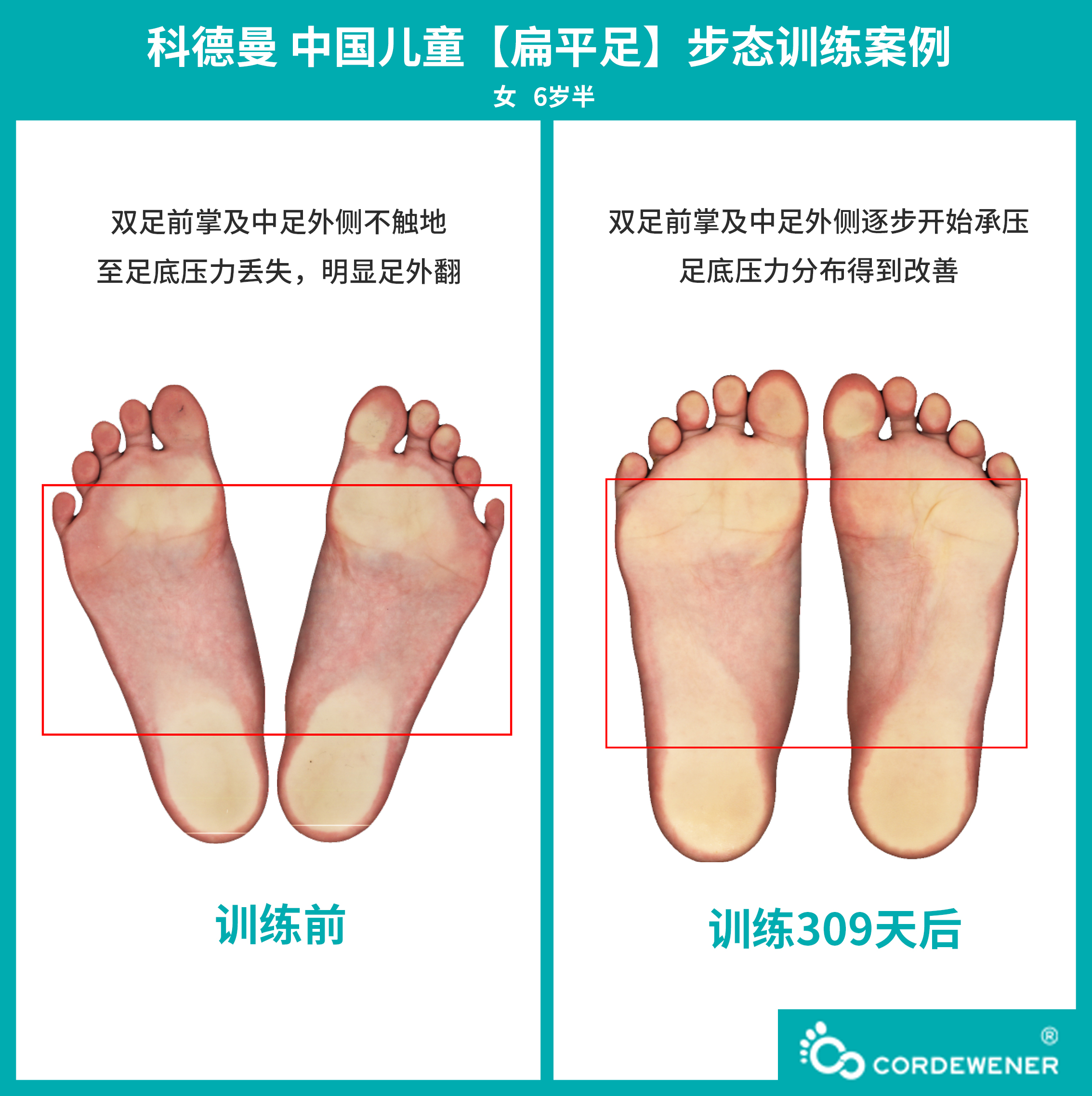 科德曼|儿童步态训练案例展示--扁平足案例十二