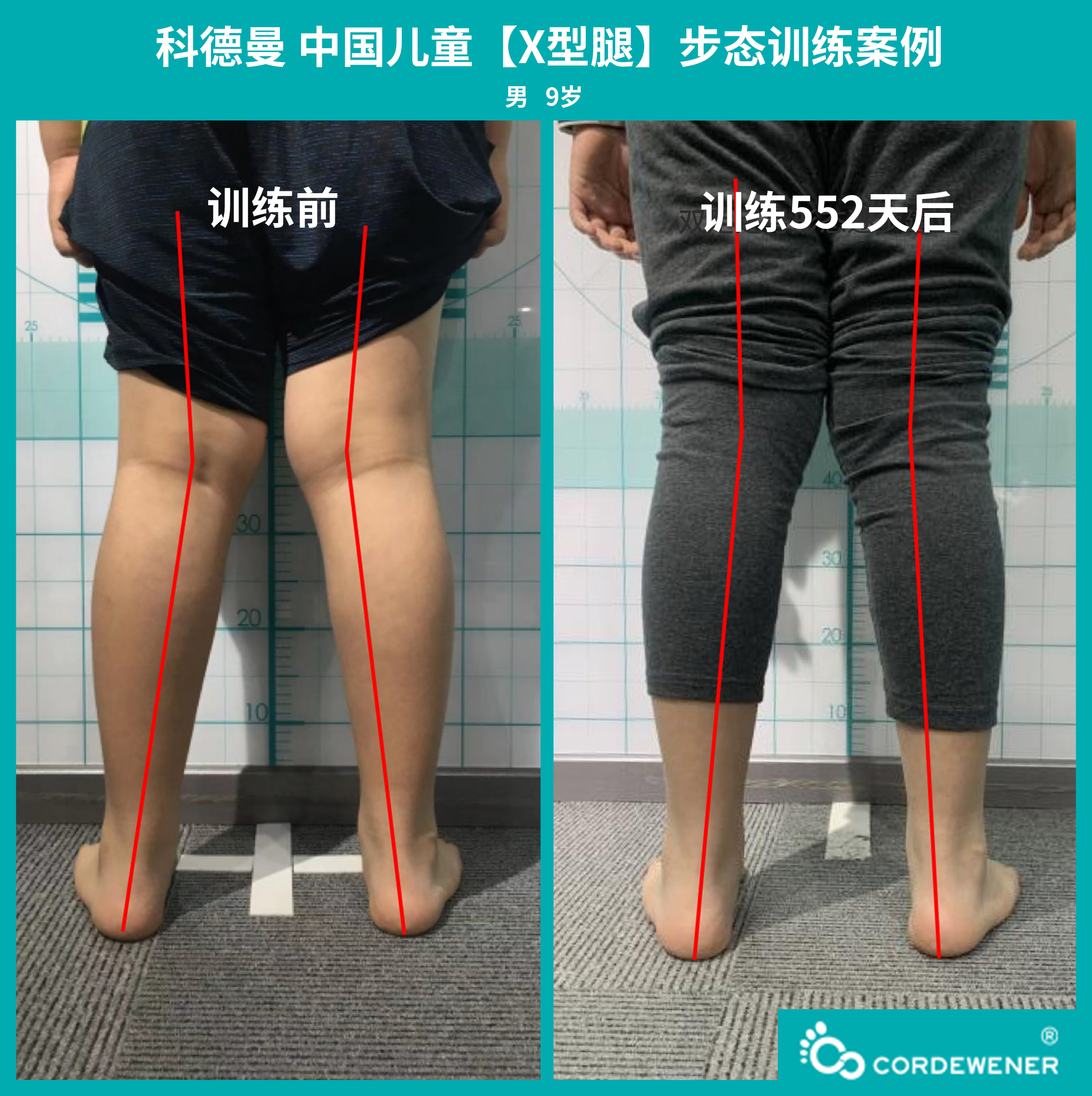 科德曼|儿童步态训练案例展示--扁平足+X型腿
