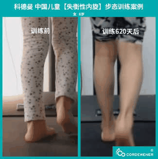 科德曼|儿童步态训练案例展示--失衡性内旋案例三