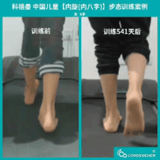 科德曼|儿童步态训练案例展示--内旋案例七