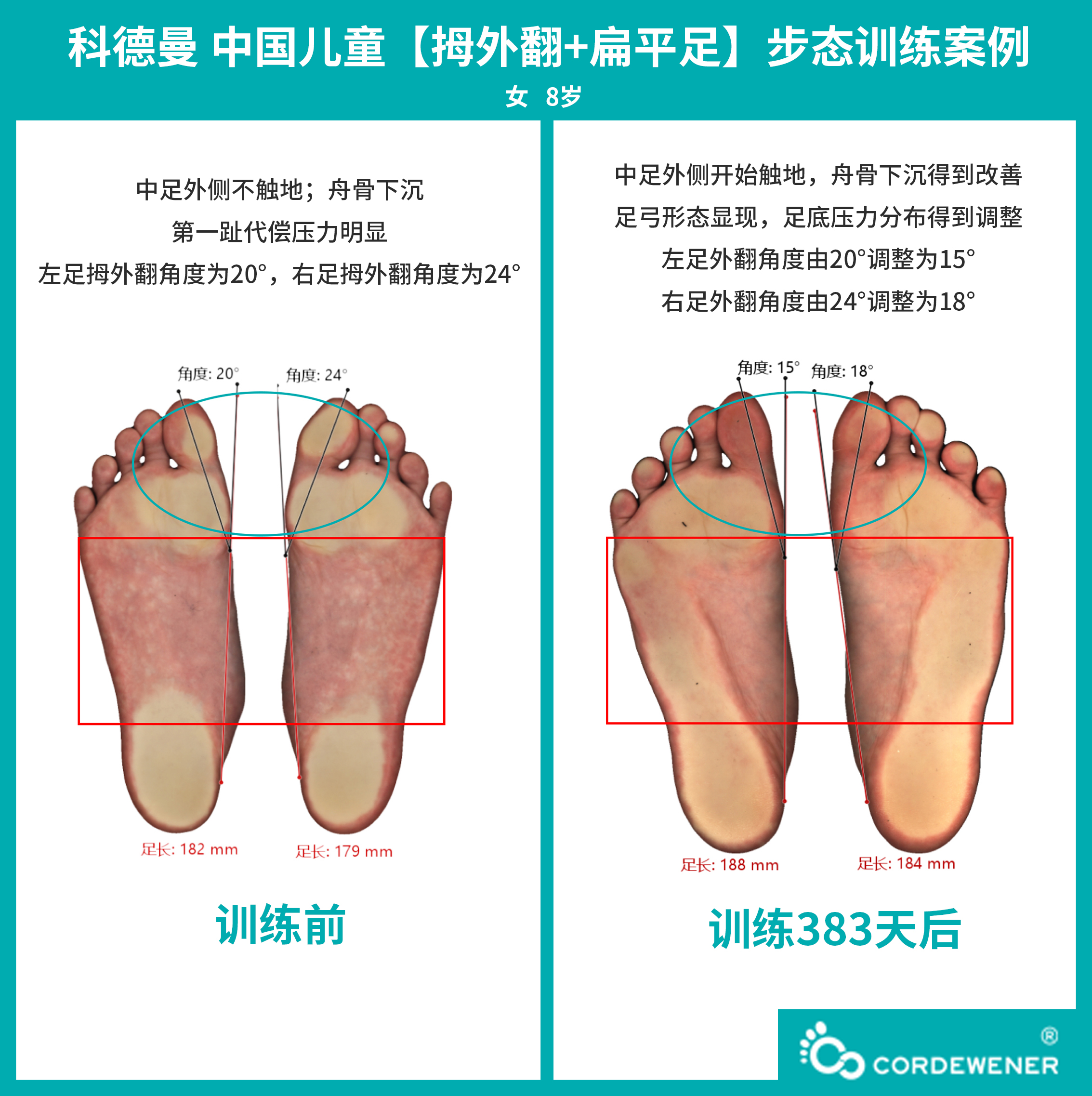 科德曼|儿童步态训练案例展示--拇外翻+扁平足案例二