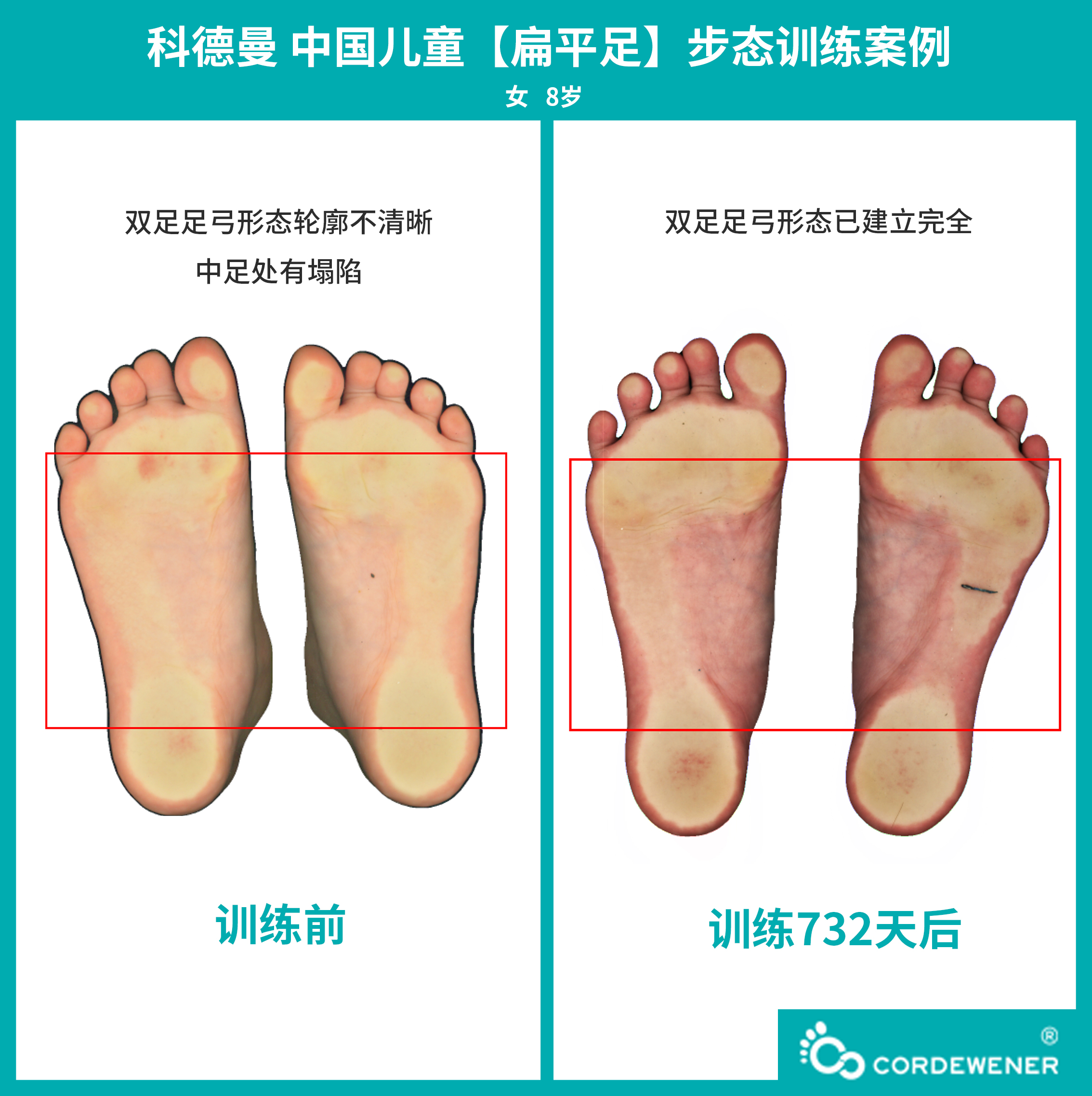 科德曼|儿童步态训练案例展示--扁平足+内旋案例二
