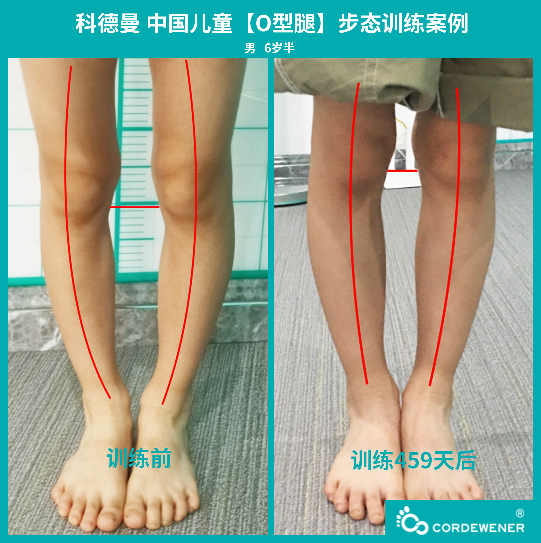 科德曼|儿童步态训练案例展示--O型腿案例四