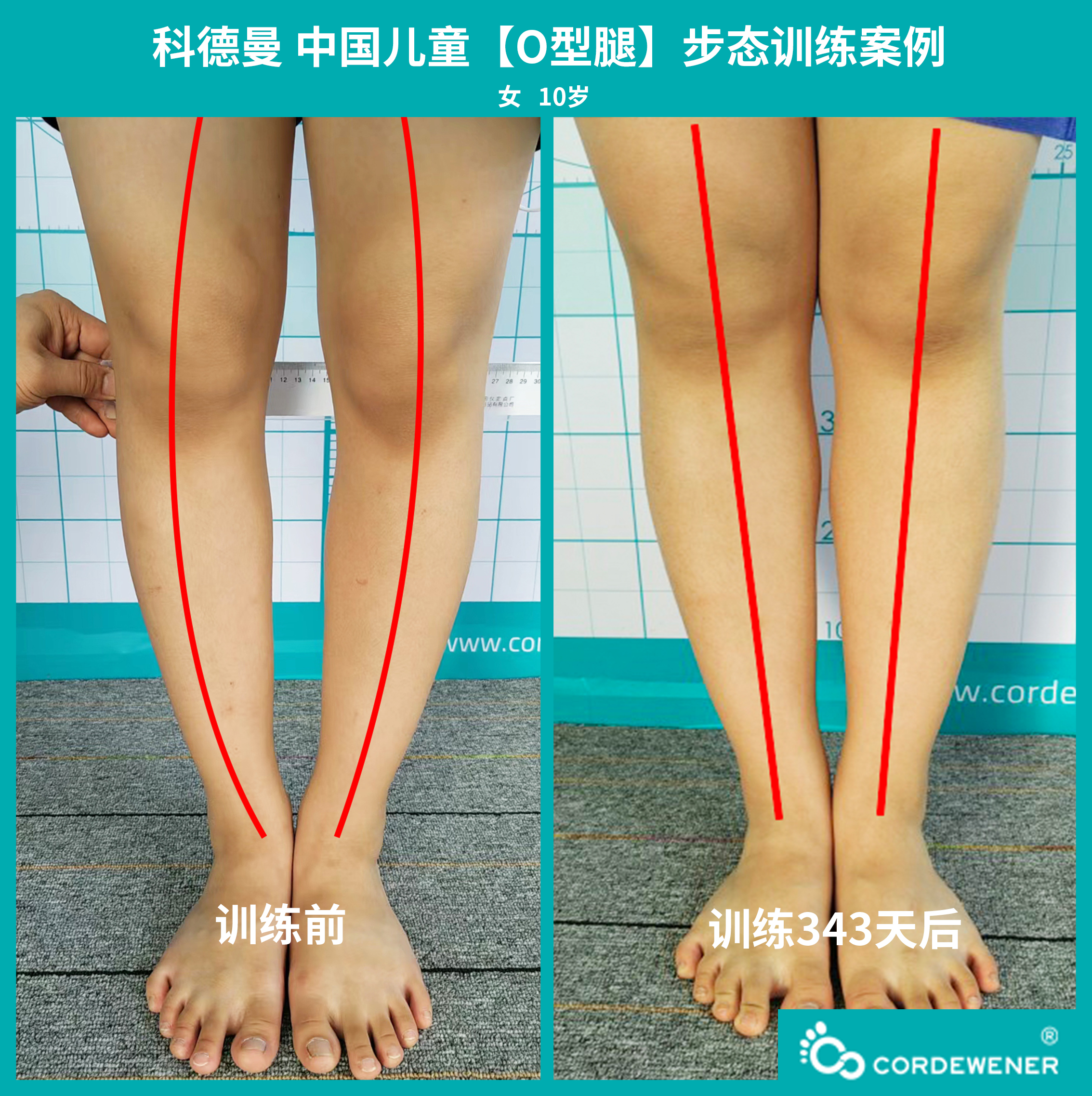 科德曼|儿童步态训练案例展示--O型腿案例三