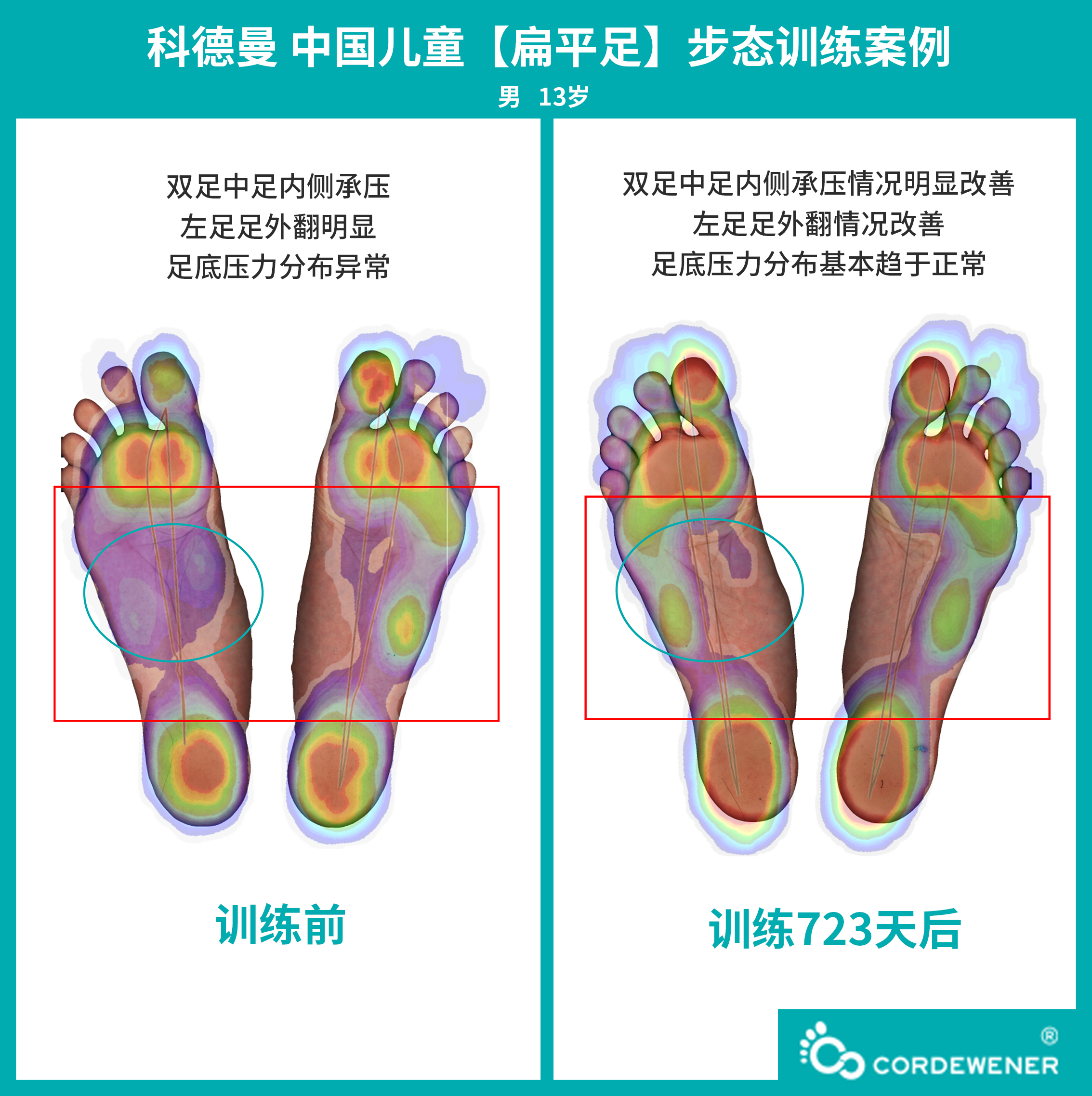 科德曼|儿童步态训练案例展示--扁平足案例十三