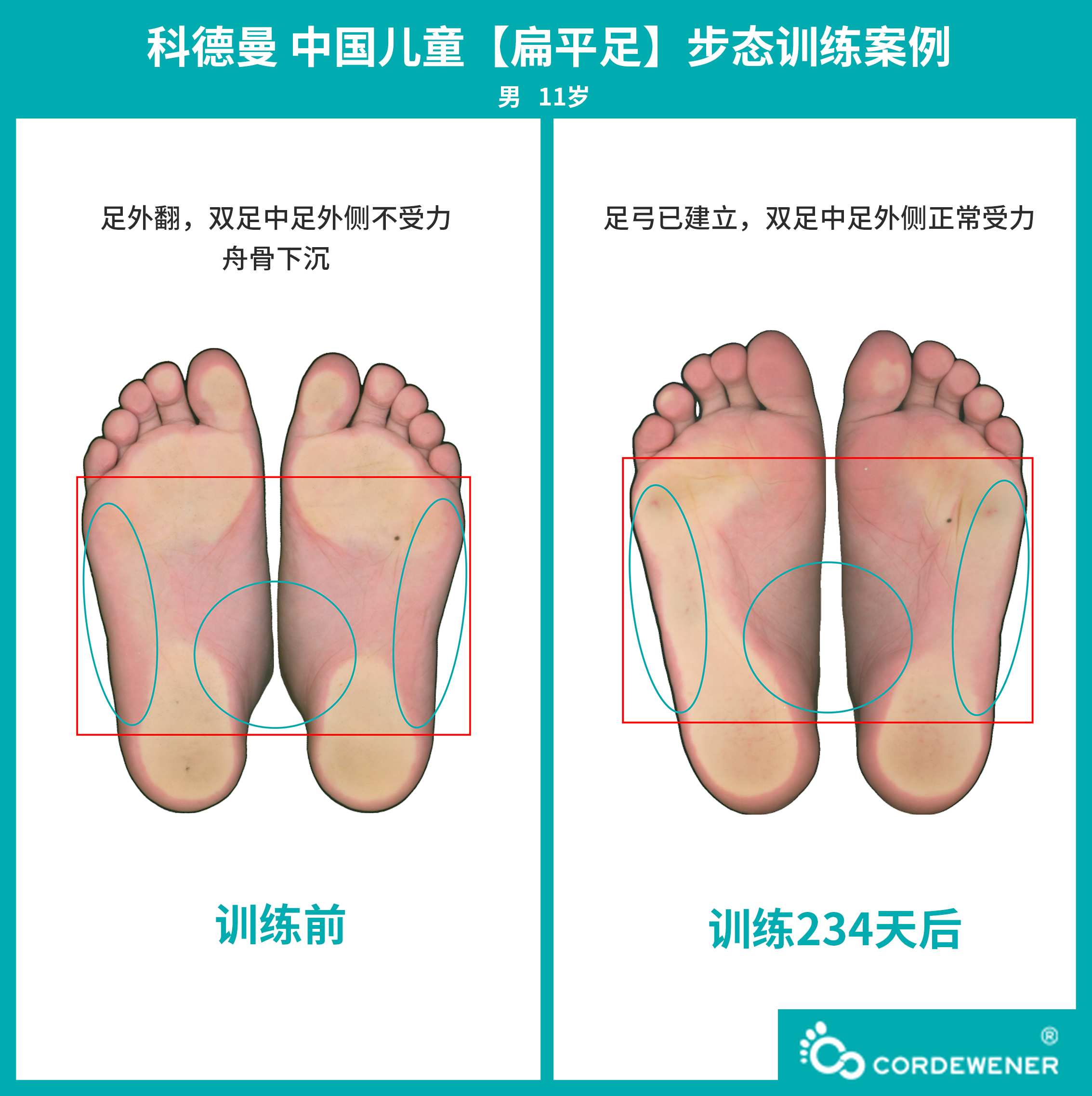 科德曼|儿童步态训练案例展示--扁平足+内旋案例六