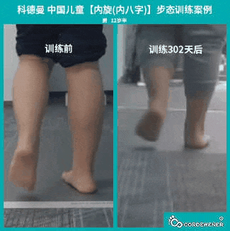 科德曼|儿童步态训练案例展示--内旋案例十九