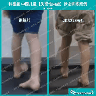 科德曼|儿童步态训练案例展示--失衡性内旋案例十七
