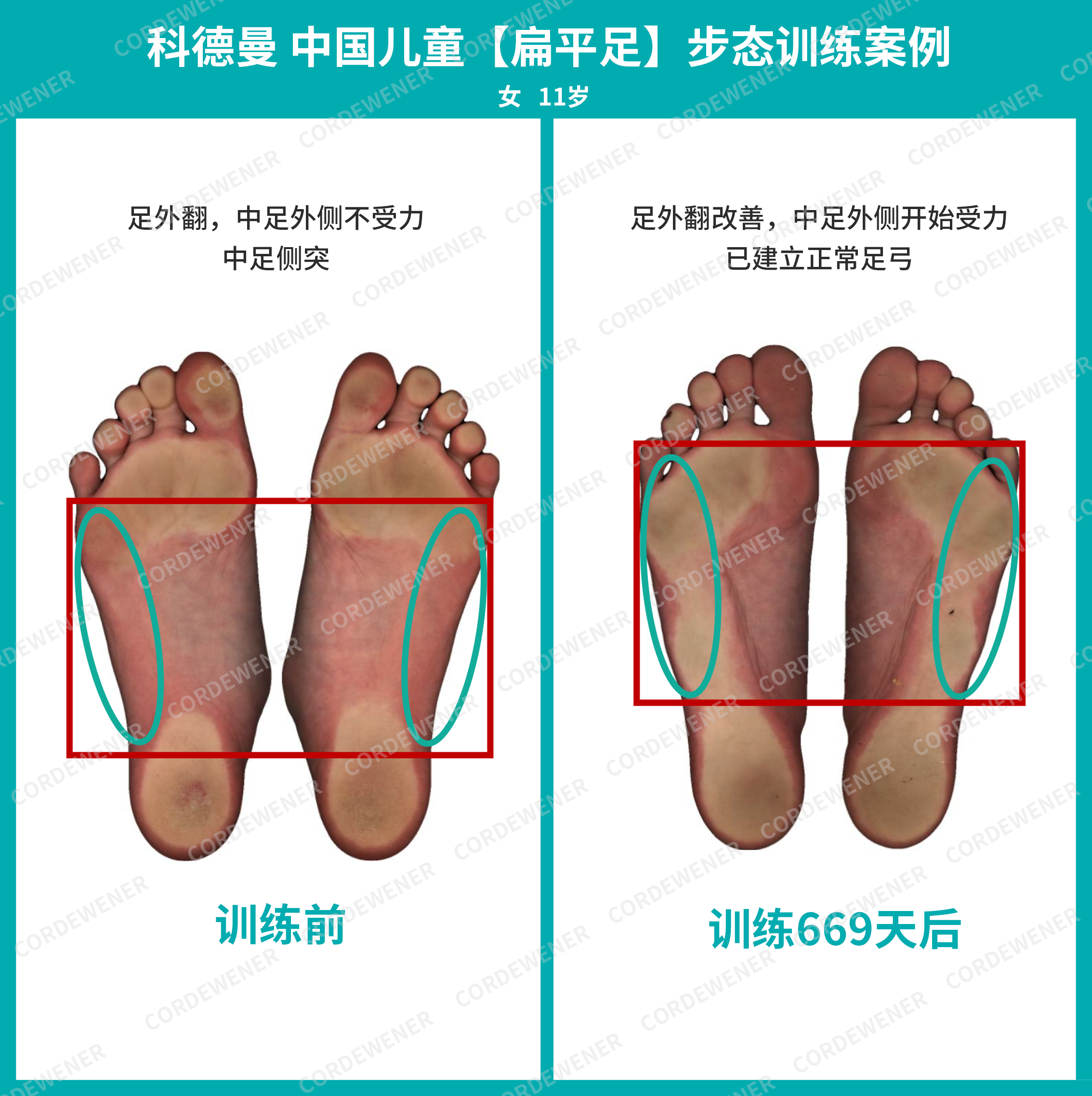 科德曼|儿童步态训练案例展示--扁平足案例四十六