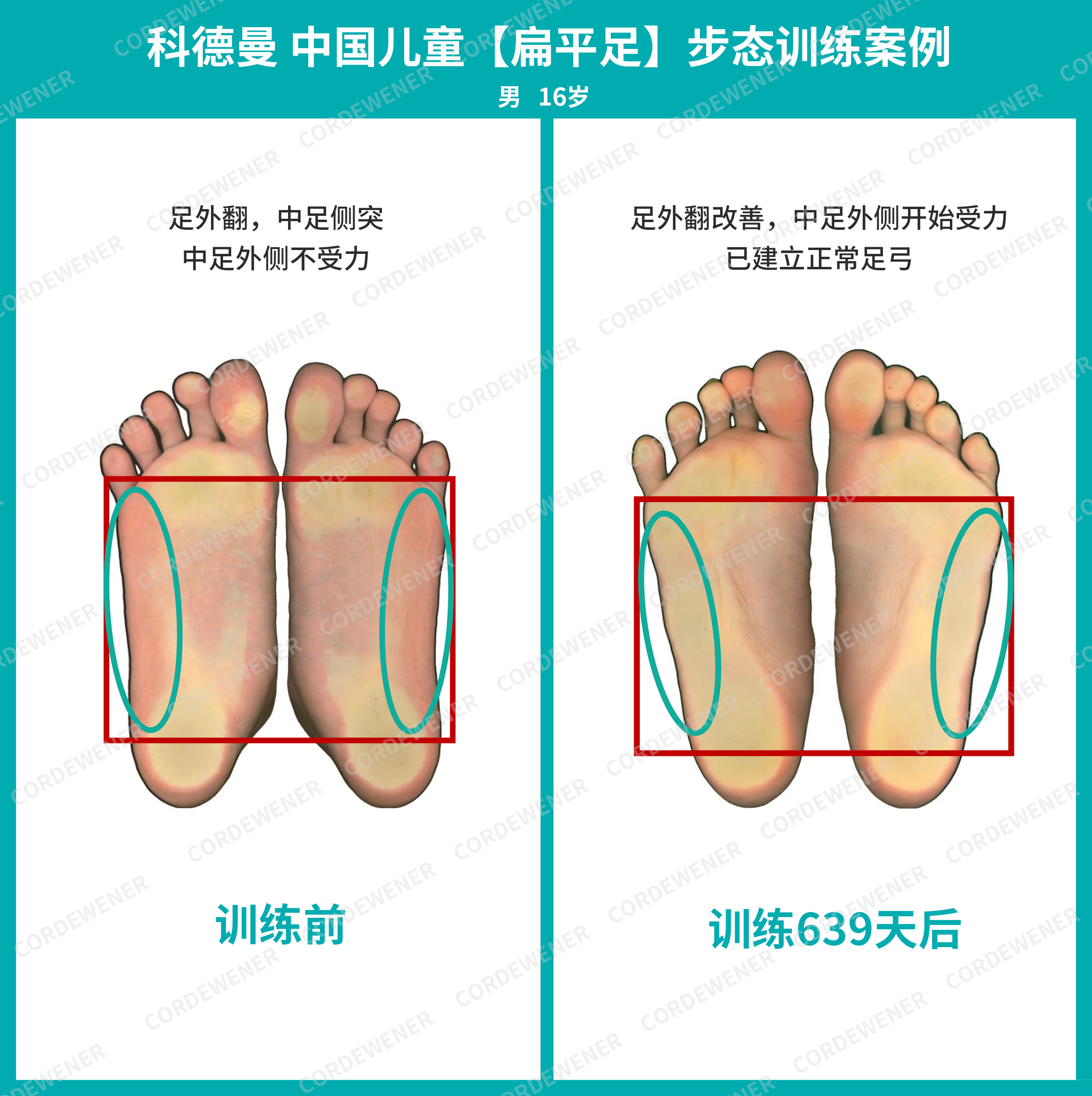 科德曼|儿童步态训练案例展示--扁平足+内旋案例十一