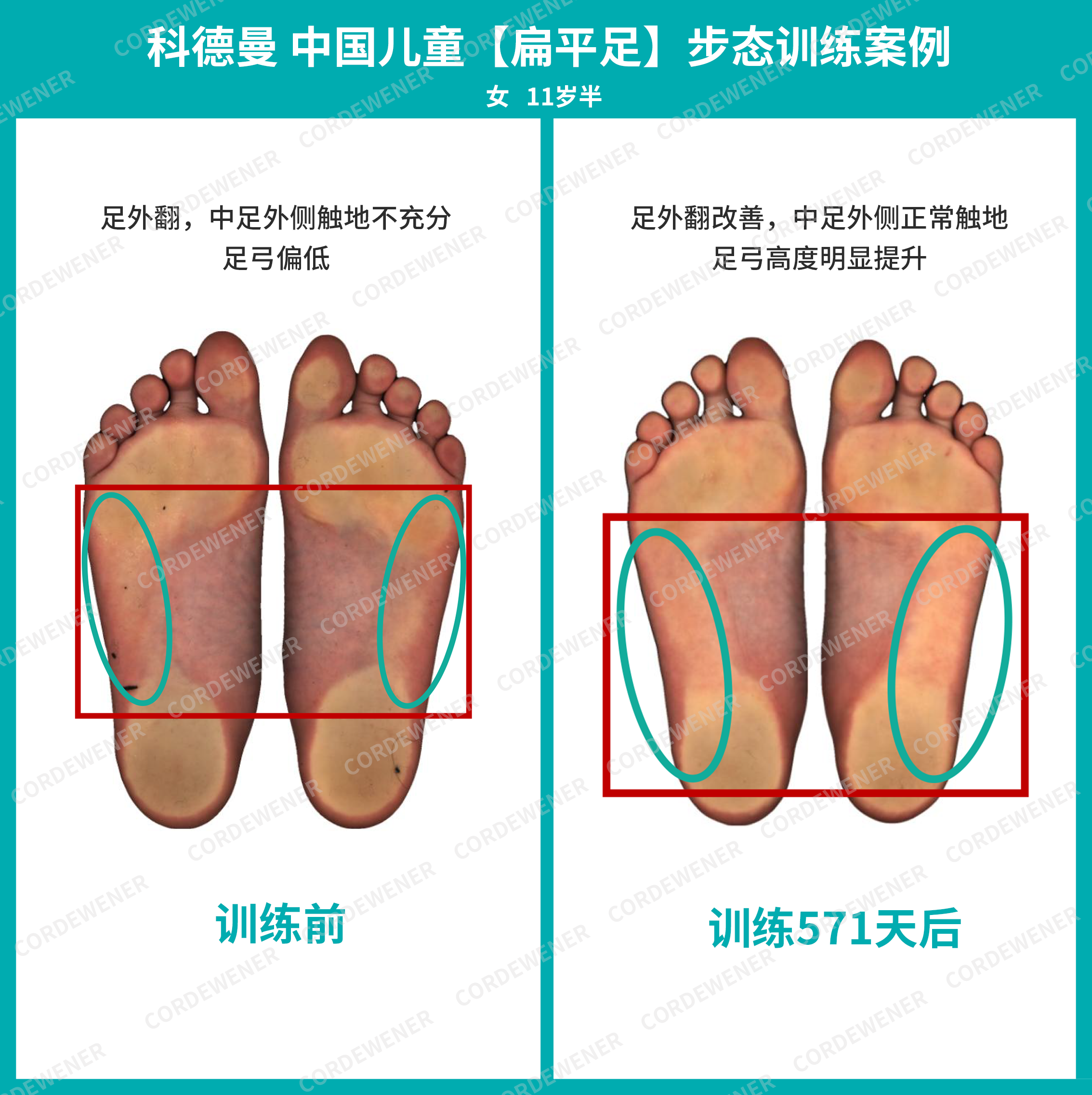 科德曼|儿童步态训练案例展示--扁平足案例四十七