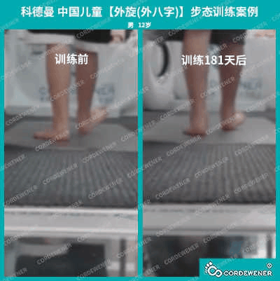 科德曼|儿童步态训练案例展示--扁平足+外旋