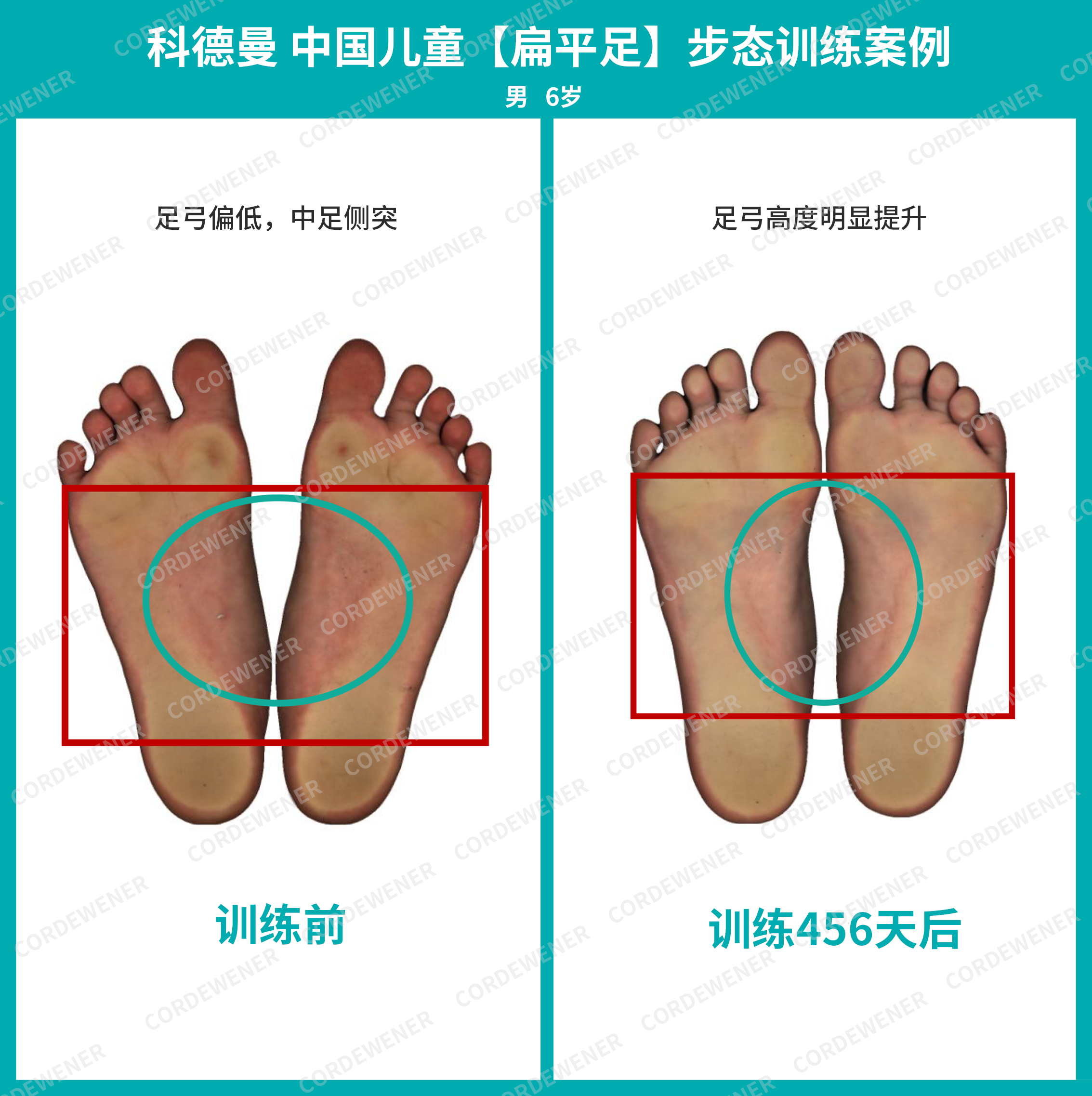 科德曼|儿童步态训练案例展示--扁平足案例四十八