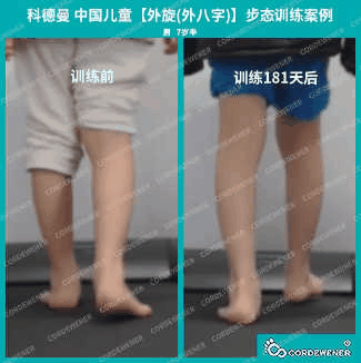 科德曼|儿童步态训练案例展示--扁平足+外旋案例二