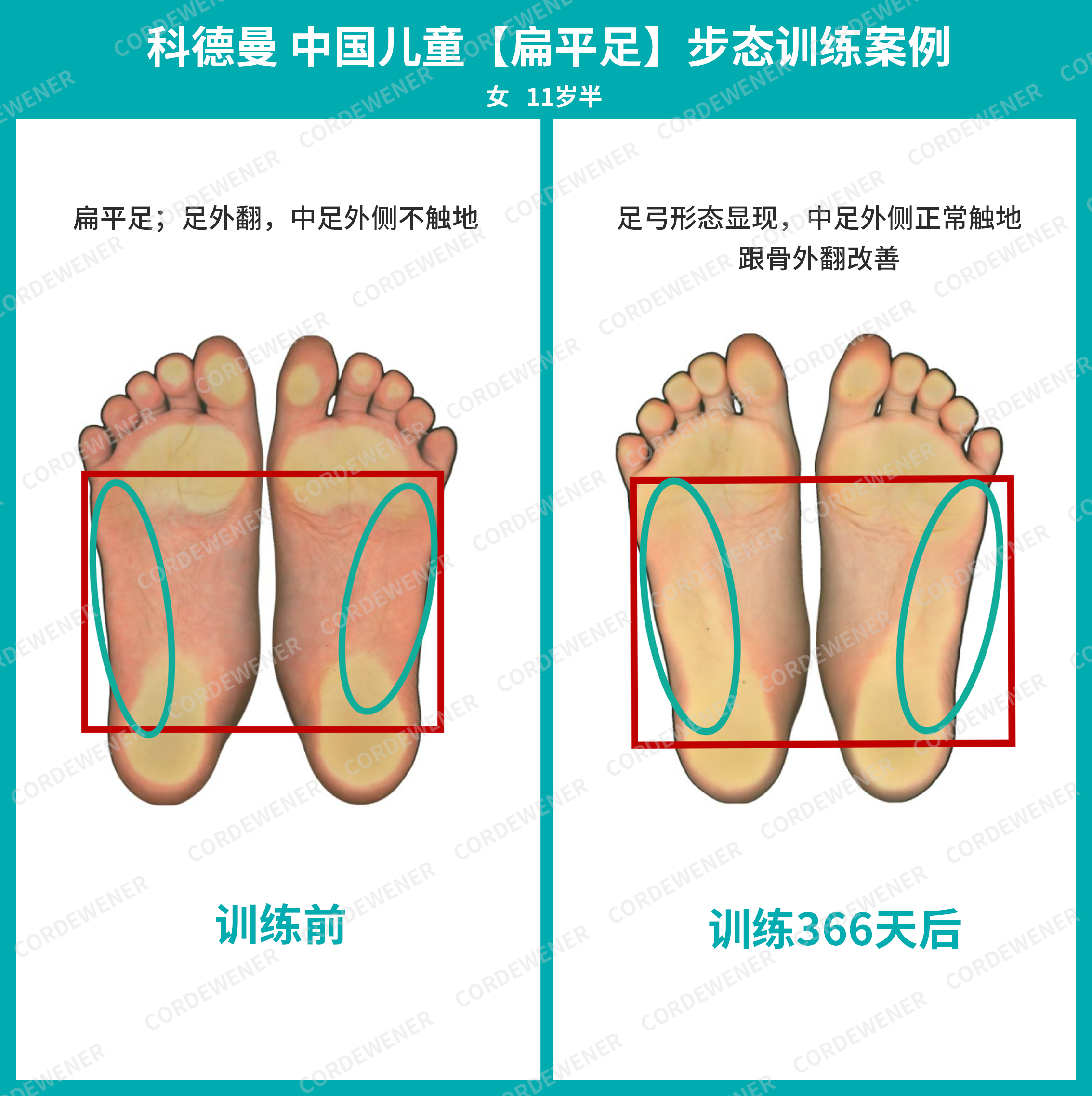 科德曼|儿童步态训练案例展示--扁平足案例四十九